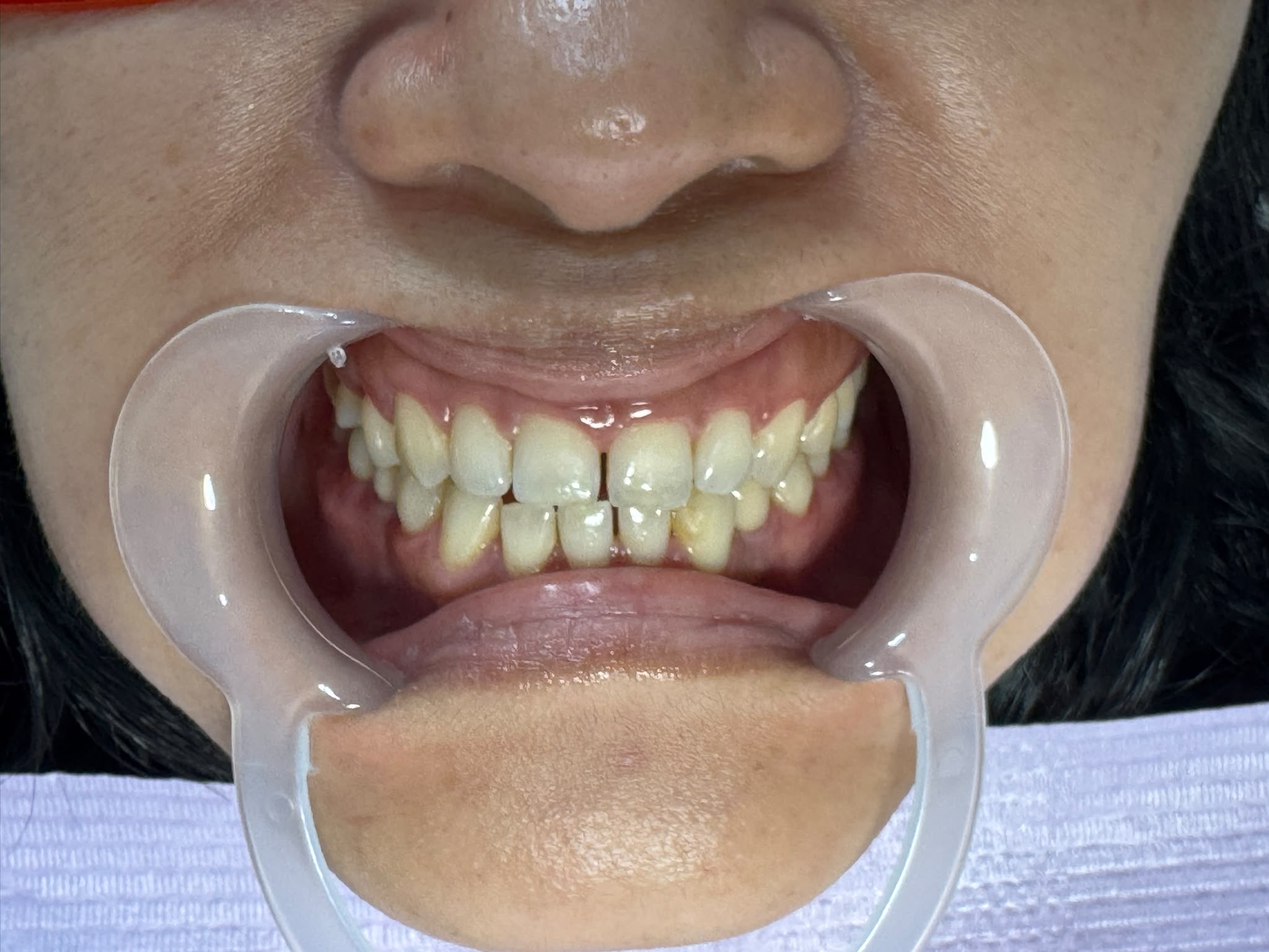 Before teeth whitening